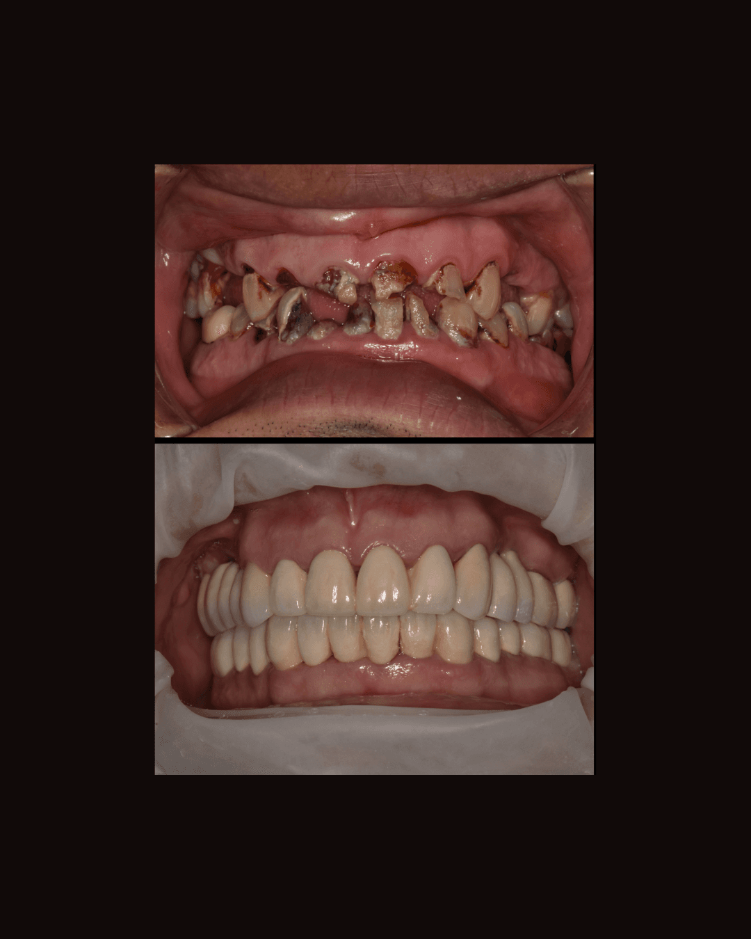 Full Mouth Rehabilitation
