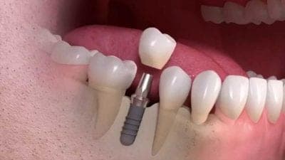 Dental Implant