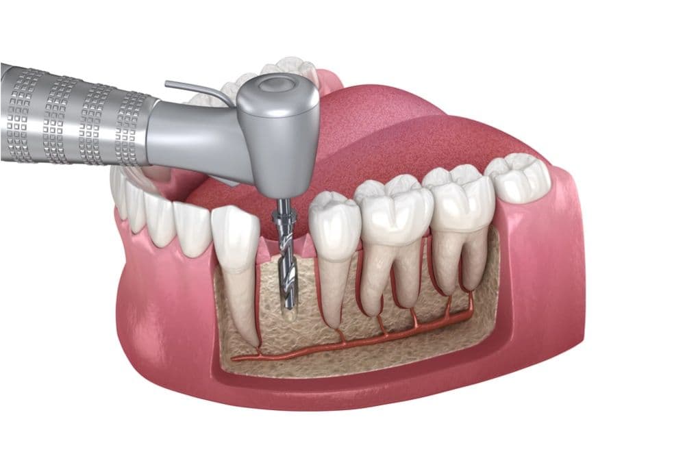 RCT (Root Canal Treatment)